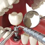 Dental Implant