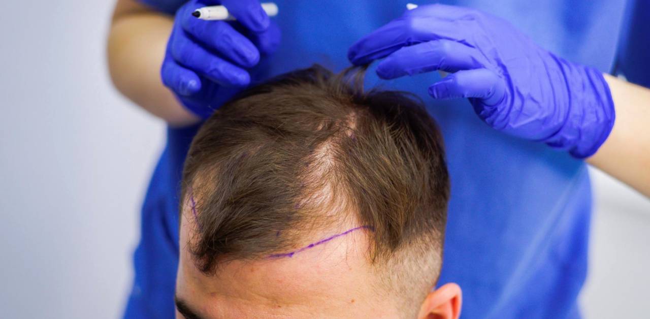 Hair Transplant