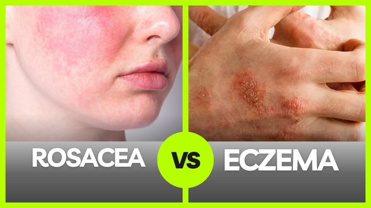 rosacea and eczema