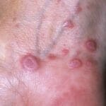 Lichen Planus Relief